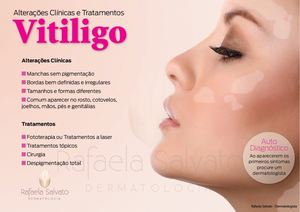 vitiligo Dra. Rafaela Salvato Dermatologista Florianópolis